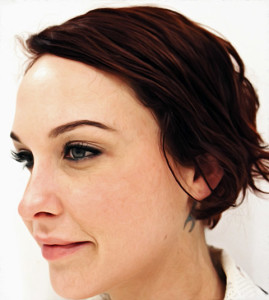 dermal fillers in Melbourne