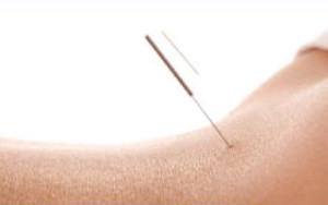 Dry Needling New Zealand